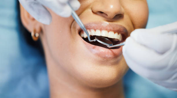 Best Knocked-Out Tooth (Avulsed Tooth) Treatment in Morningside, MD